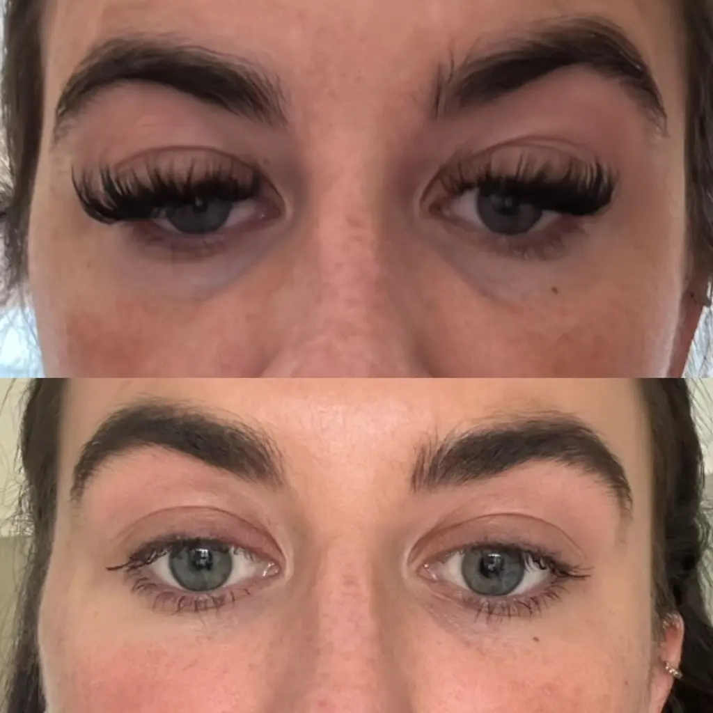 Advanced Dermal Filler before and after result 1