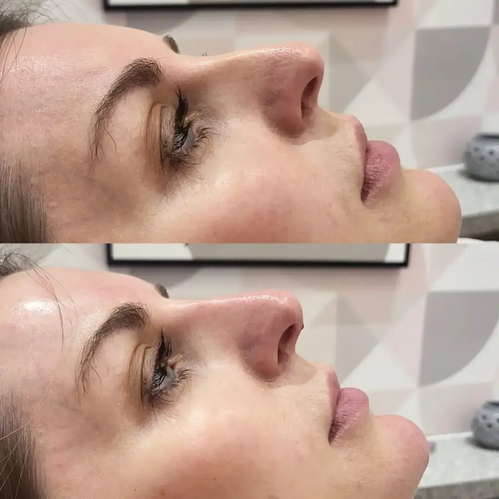 Advanced Dermal Filler before and after result 2