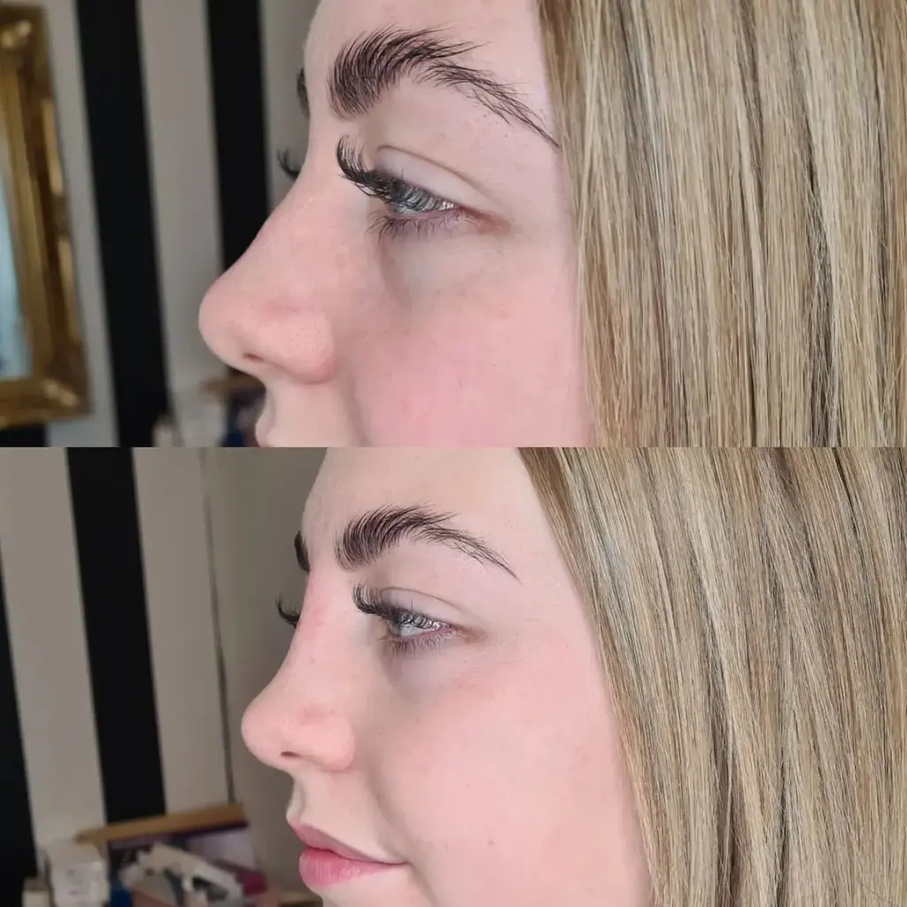 Advanced Dermal Filler before and after result 3