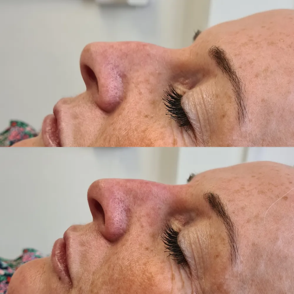 Advanced Dermal Filler before and after result 4