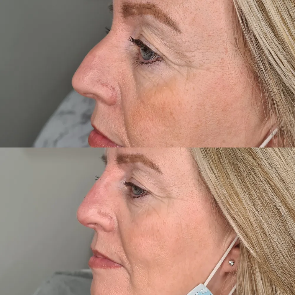 Advanced Dermal Filler before and after result 5