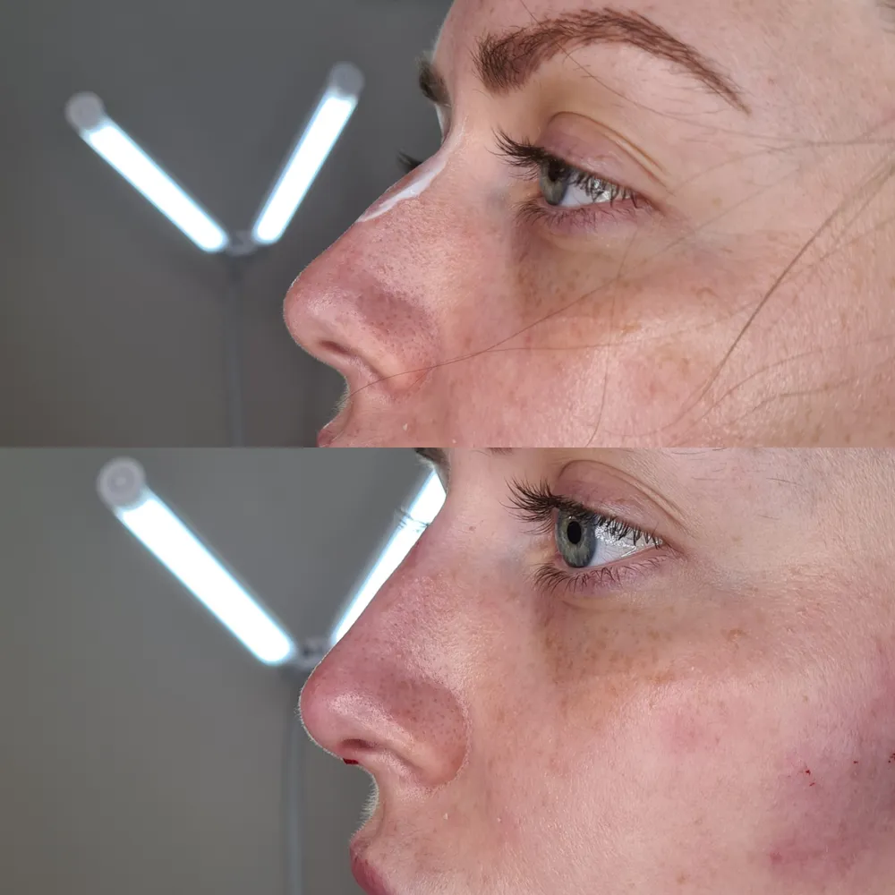 Advanced Dermal Filler before and after result 6
