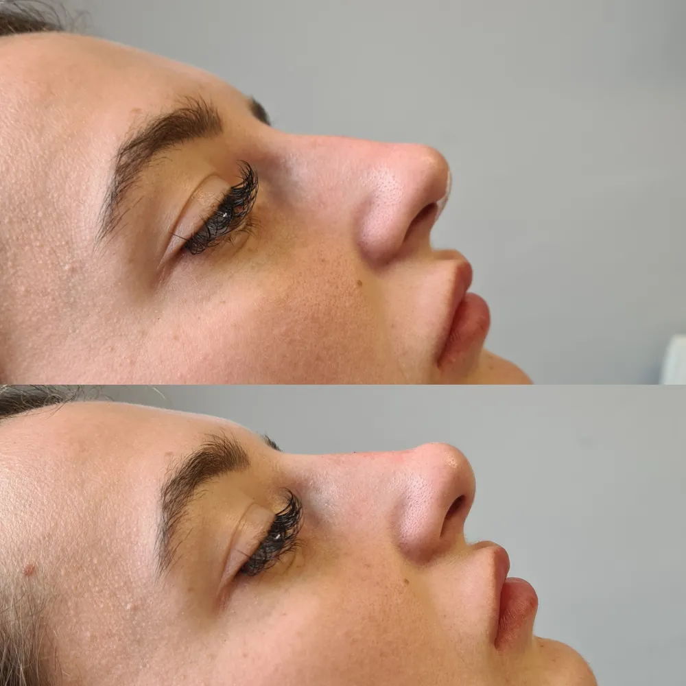 Advanced Dermal Filler