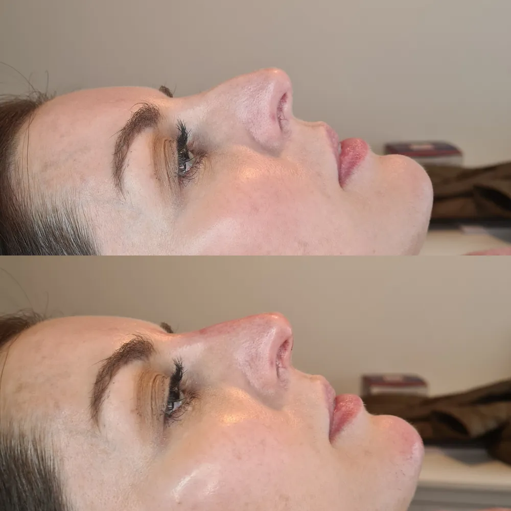 Advanced Dermal Filler before and after result 8