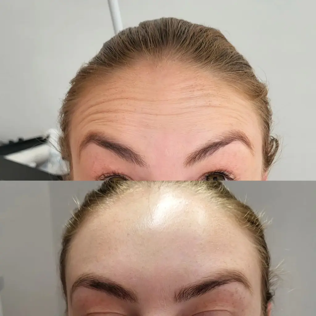 Anti-Wrinkle Injections before and after result 1