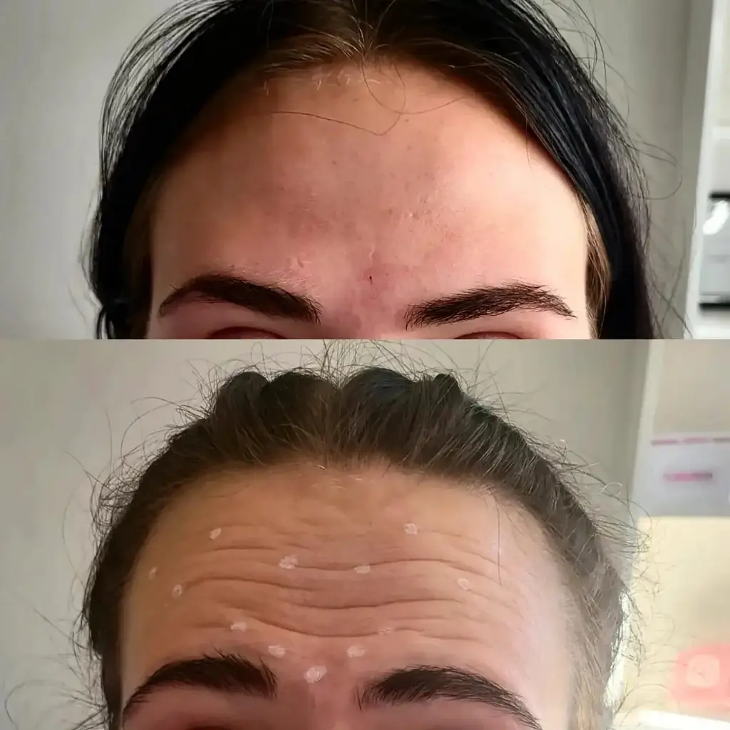 Anti-Wrinkle Injections before and after result 2