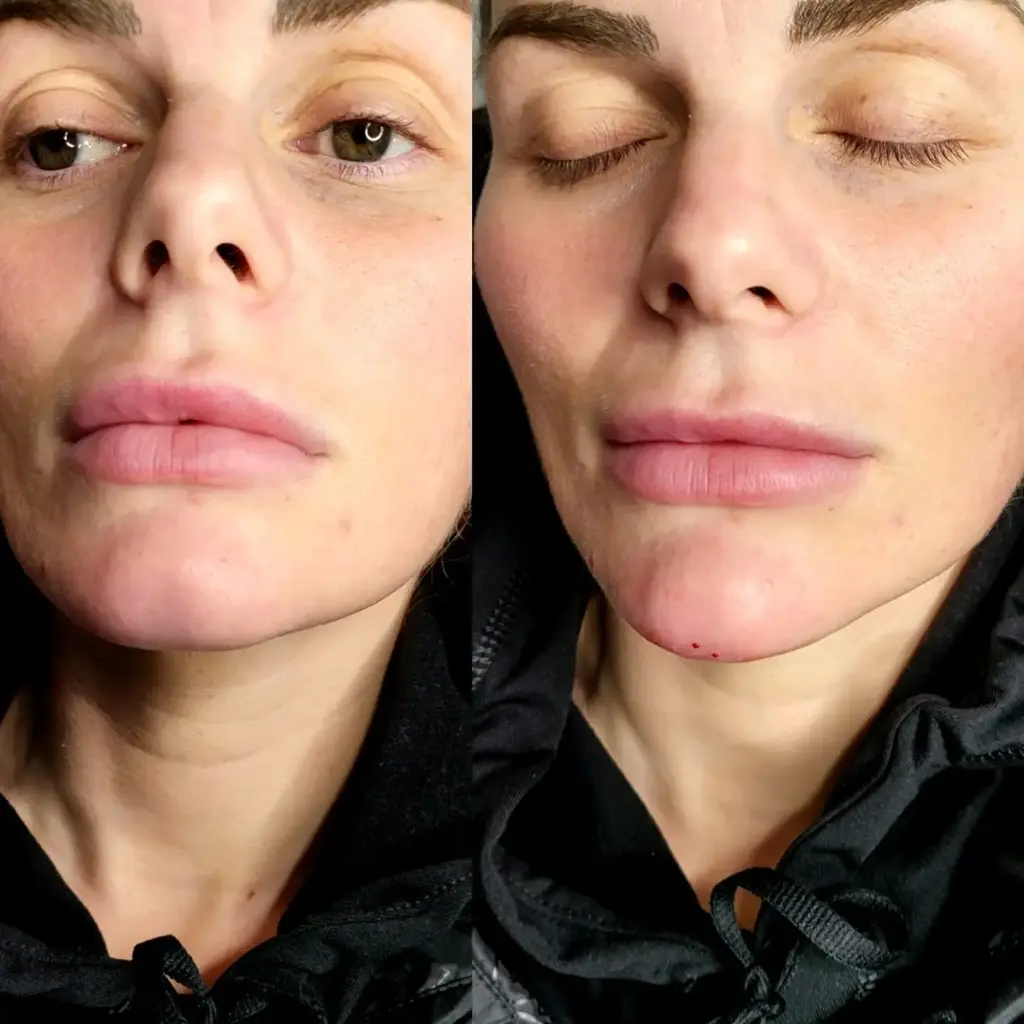 Dermal Fillers before and after result 1