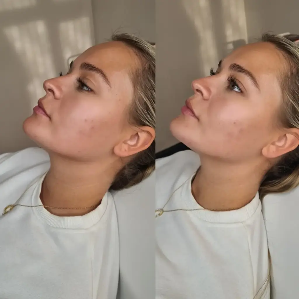 Dermal Fillers before and after result 2