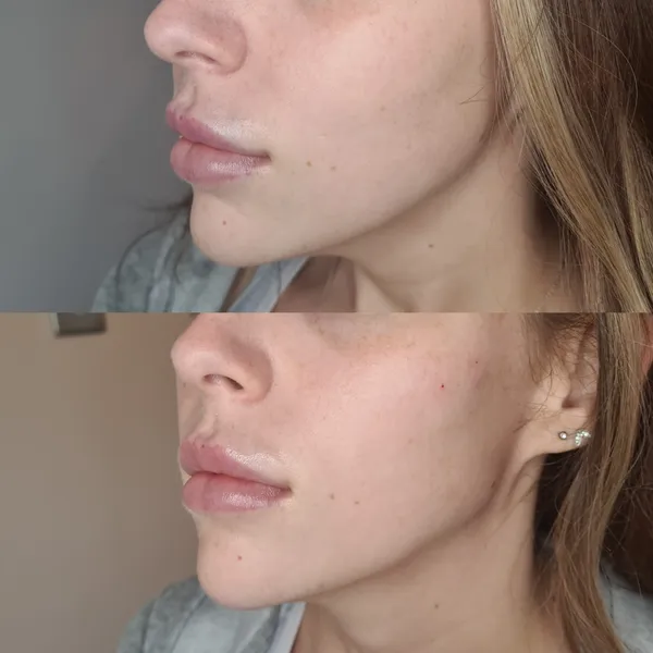 Dermal Fillers before and after result 4