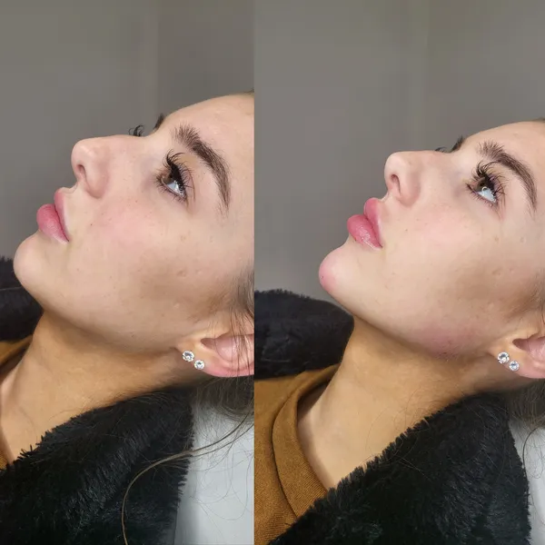 Dermal Fillers before and after result 5
