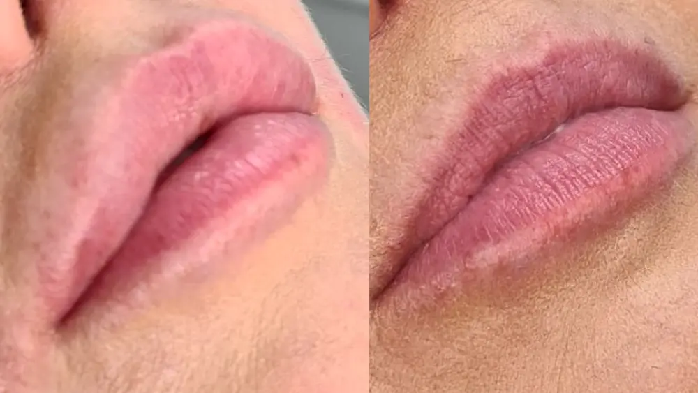 Dissolving Treatment