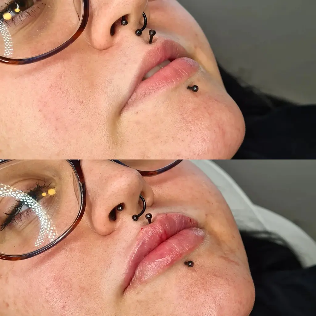 Lip Filler before and after result 1