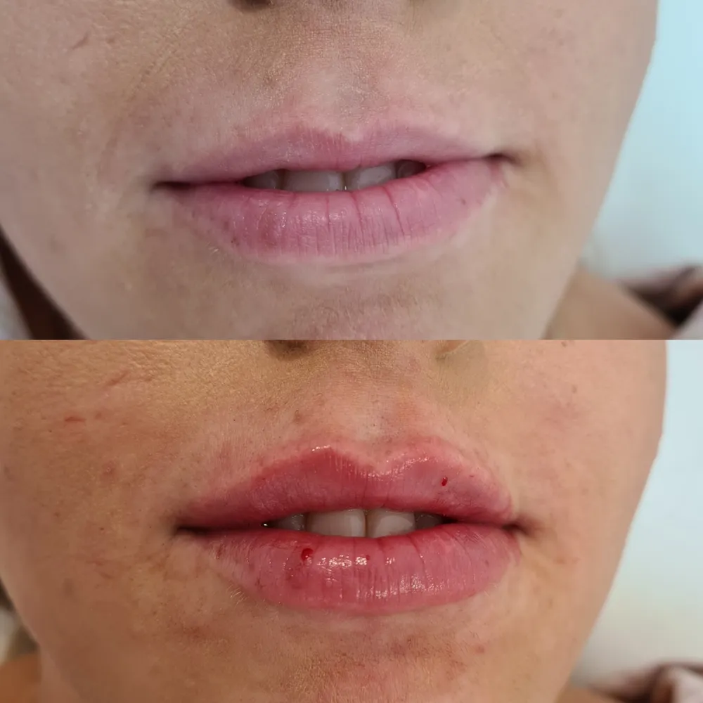 Lip Filler before and after result 10