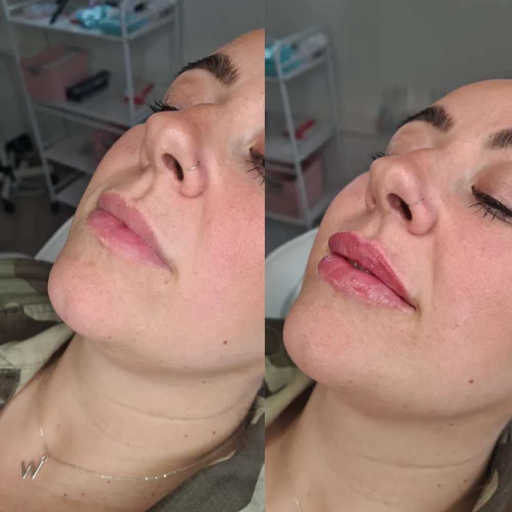 Lip Filler before and after result 11