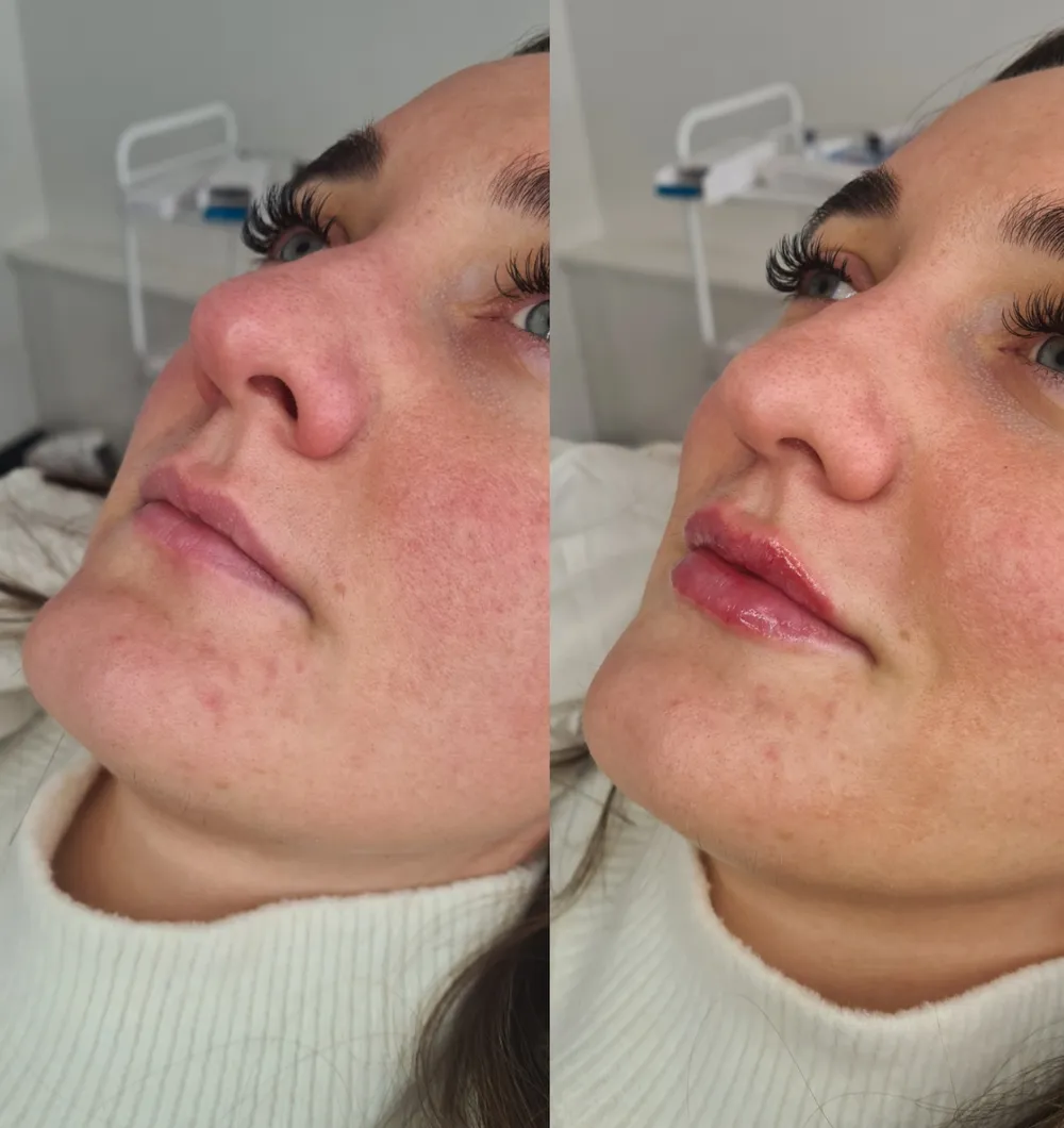 Lip Filler before and after result 12