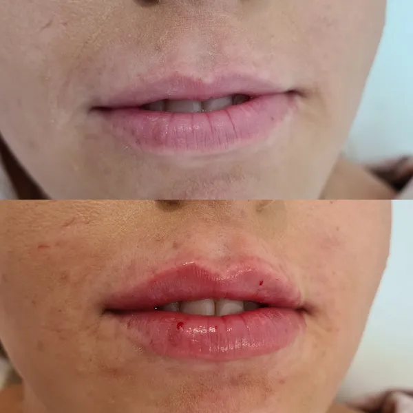 Lip Filler before and after result 14