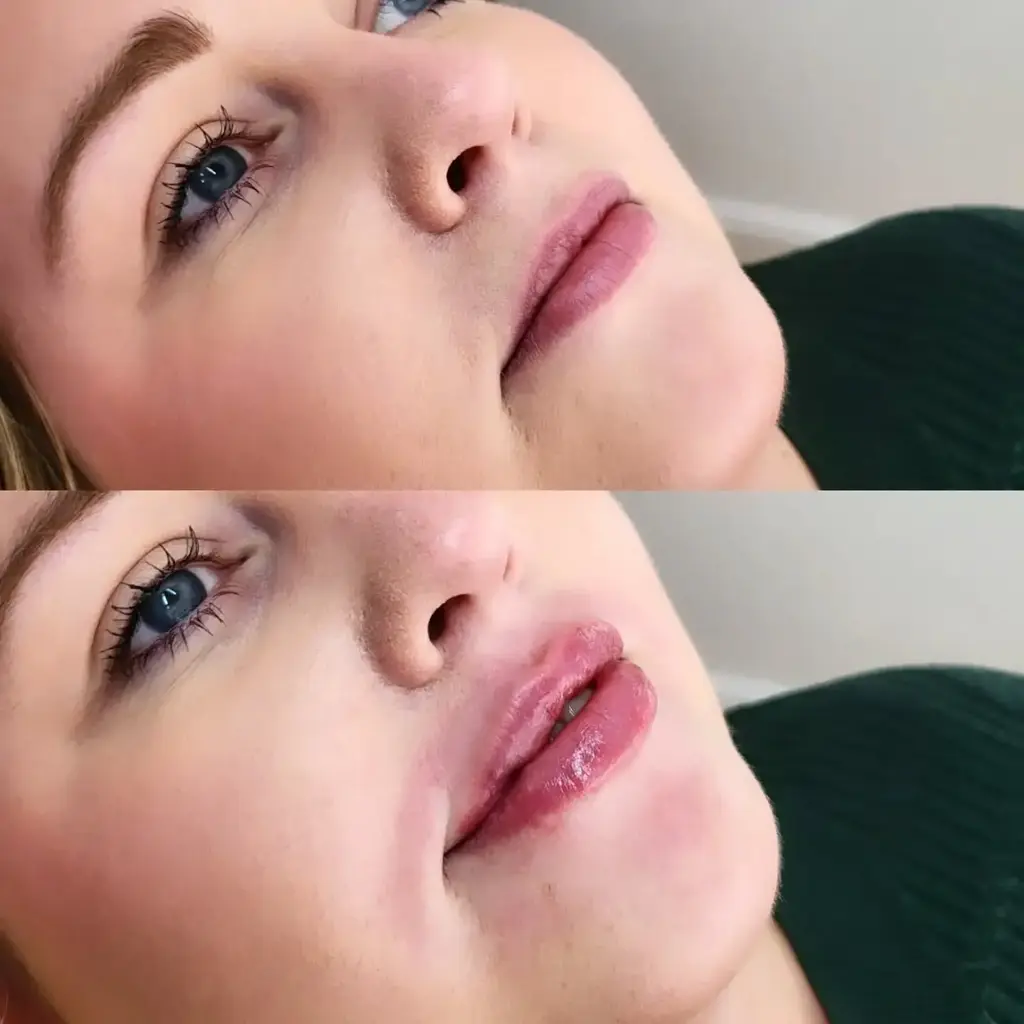 Lip Filler before and after result 2