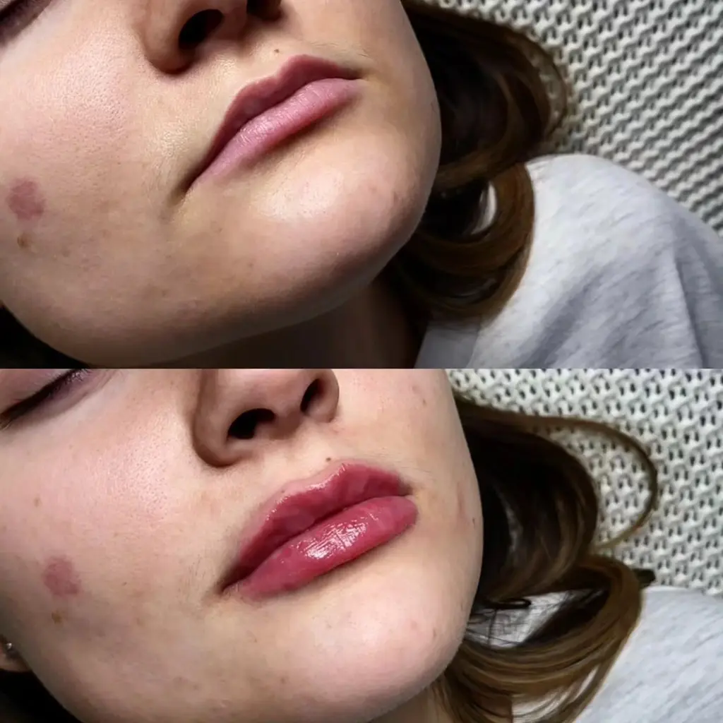 Lip Filler before and after result 3