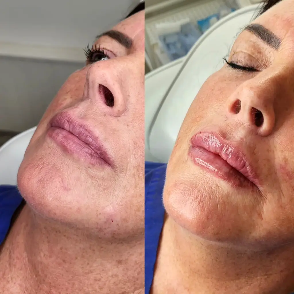 Lip Filler before and after result 4