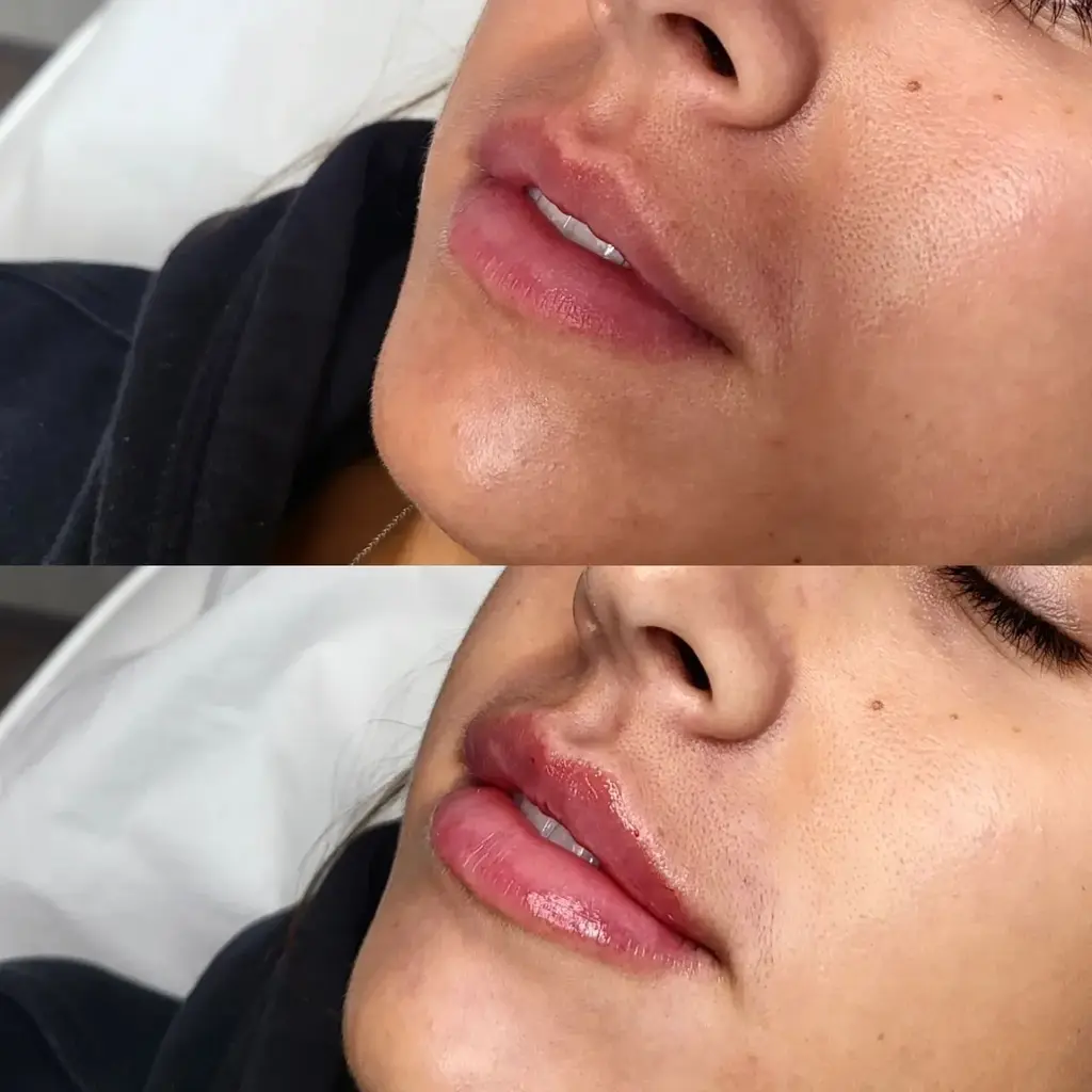 Lip Filler before and after result 5
