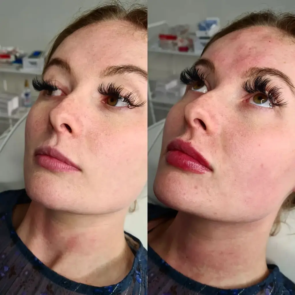 Lip Filler before and after result 6