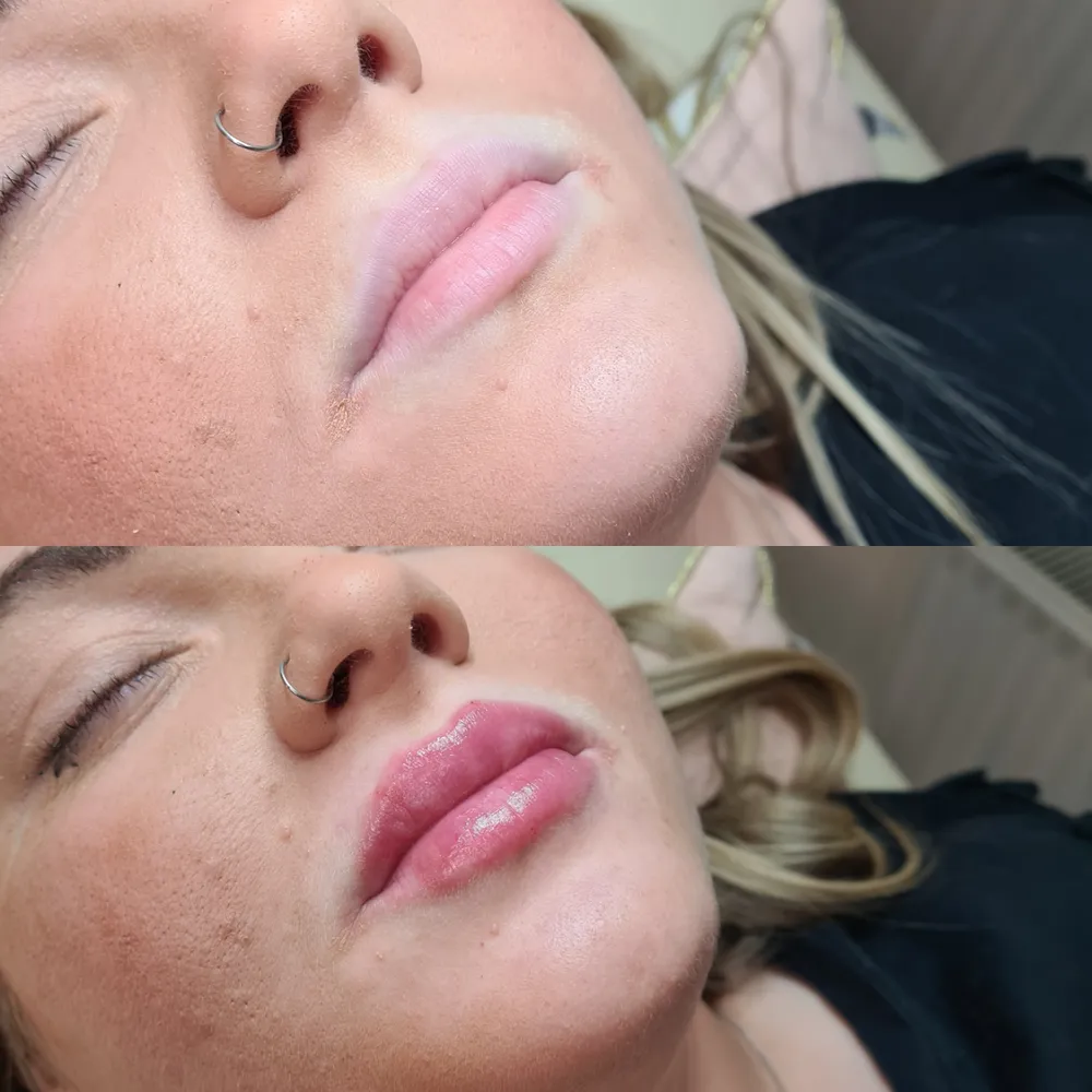 Lip Filler before and after result 7