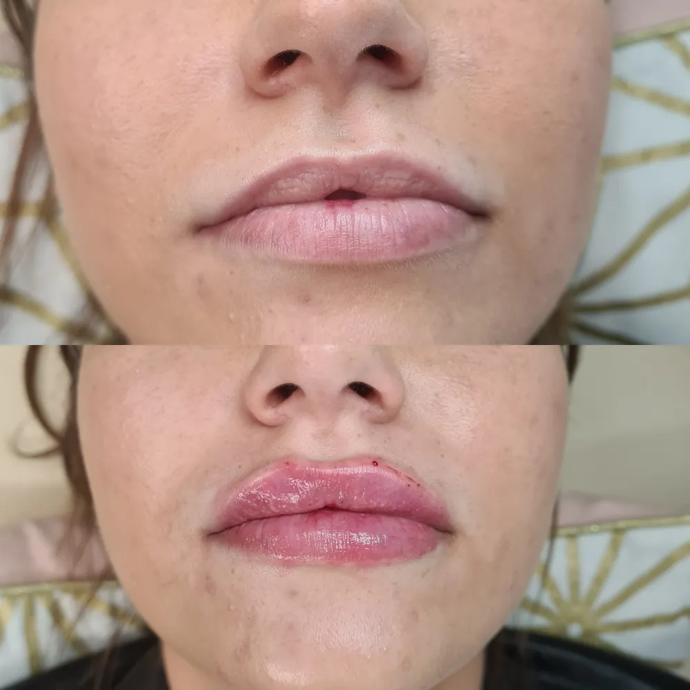 Lip Filler before and after result 8