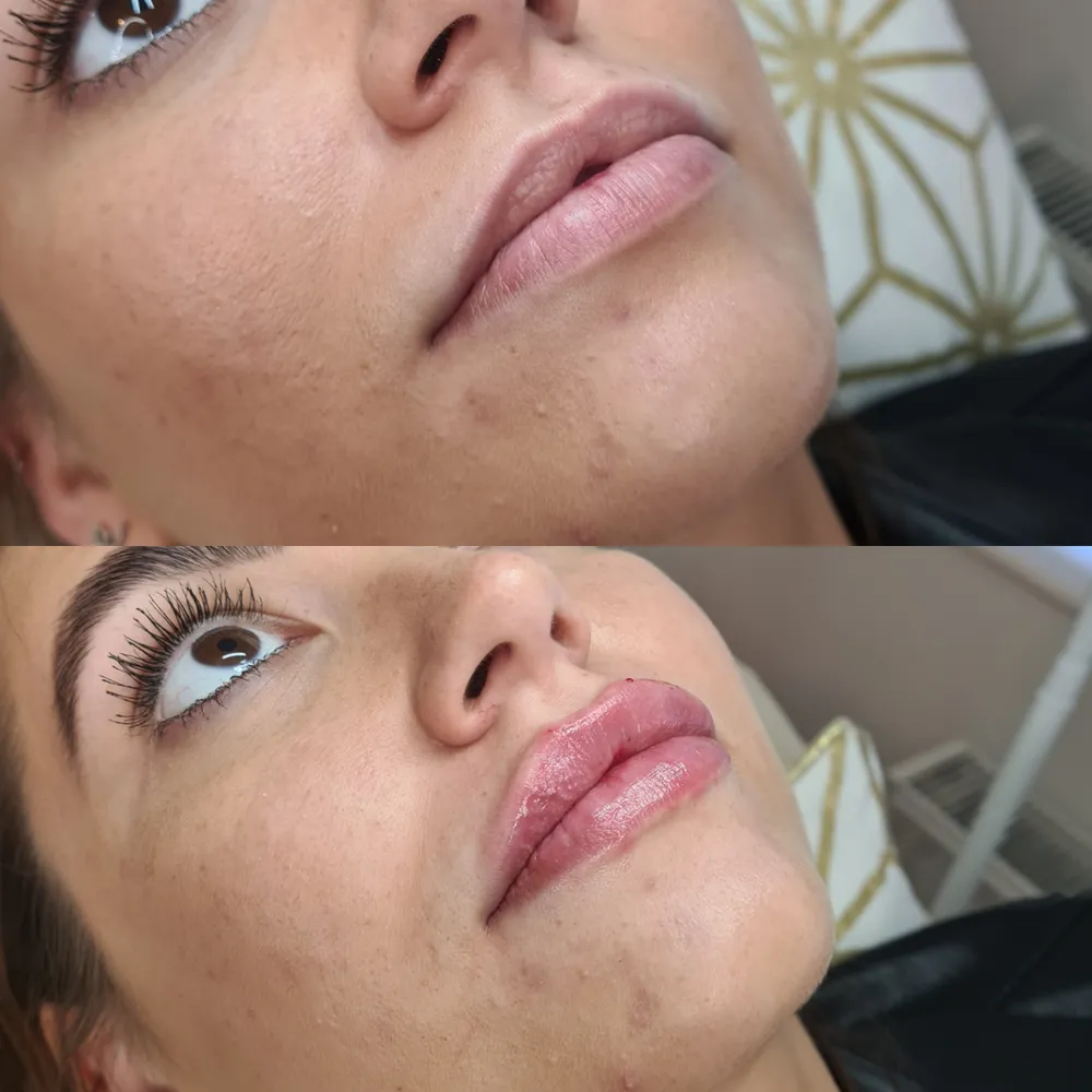 Lip Filler before and after result 9