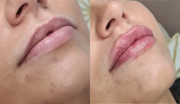 Lip Filler