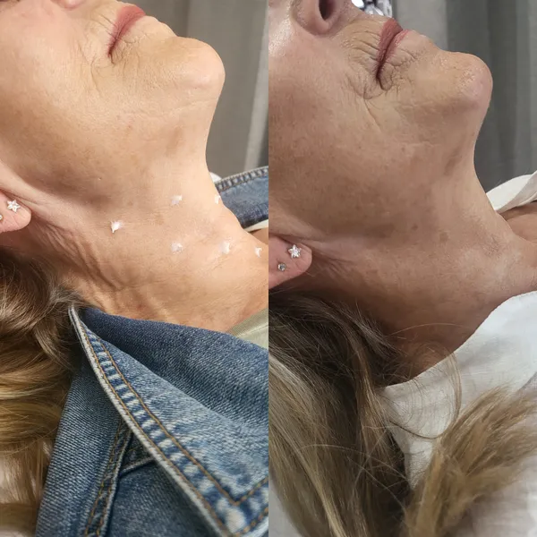 Skin Boosters before and after result 2