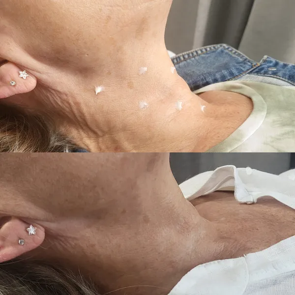 Skin Boosters before and after result 3